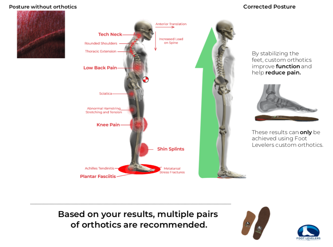 Foot Levelers Custom Orthotics | Aranibar Chiropractic
